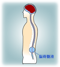 脳脊髄液減少症