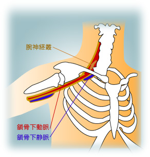 外傷性胸郭出口症候群